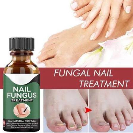 Day Nail Fungal Treatment Serum Foot Toe Nail Fungus Removal