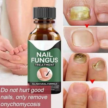 Day Nail Fungal Treatment Serum Foot Toe Nail Fungus Removal